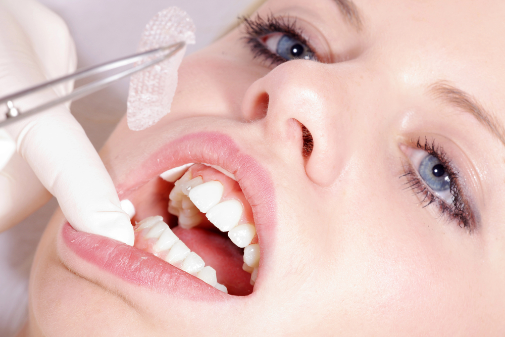 Colocar dentes novos é possível para qualquer pessoa? 1 Colocar dentes novos